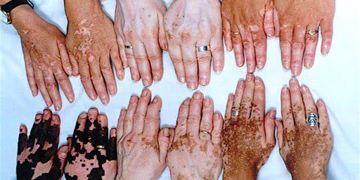 Associação realiza feira de conscientização sobre o Vitiligo